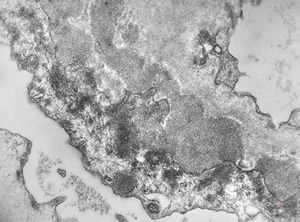 M,58y. | membranous glomerulopathy -early stage M,58y. | membranous glomerulopathy -early stage
